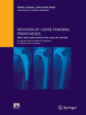 cover image of Revision of loose femoral prostheses with a stem system based on the "press-fit" principle